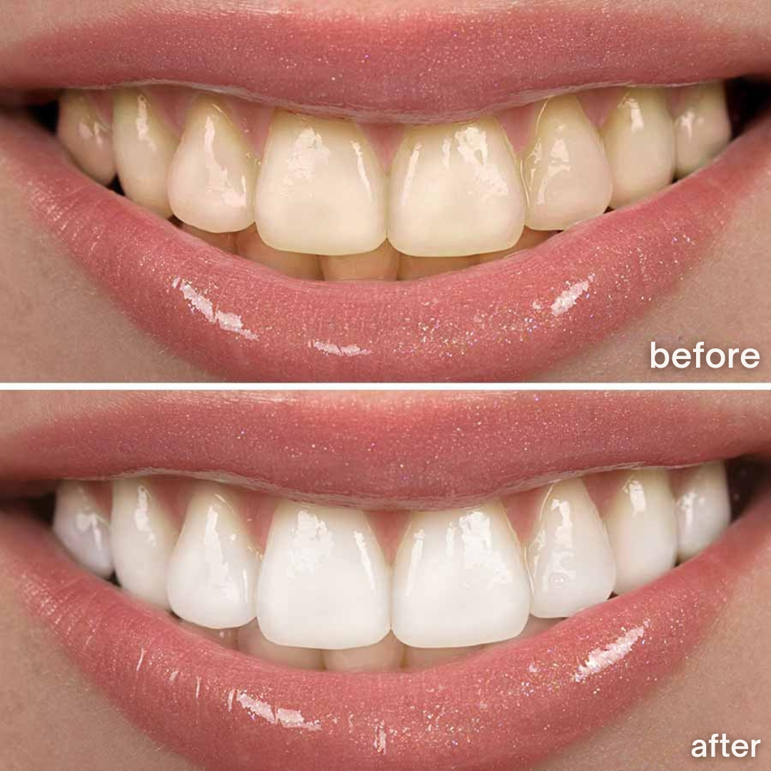 Sonic White - sonic toothbrush for radiant white teeth